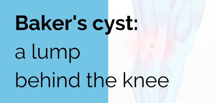 Baker's cyst: a lump behind the knee - Sports Injury | Online