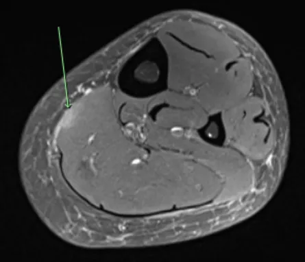 This image shows a Soleus strain, grade 1